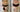 Before and after abdomen picture of Biostimulator treatment and CO2 laser done in midtown NYC at Dr Cris Studio