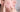 The Most Effective Chemical Peels for Acne Scars - DR. CRIS STUDIO
