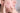 The Most Effective Chemical Peels for Acne Scars - DR. CRIS STUDIO