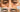 Under-Eye Filler in NYC: How Long It Lasts, Cost & Who It's Right For