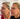 Antes e despues de hilos PDO faciales para lifting sin cirurgia en Dr Cris Studio midtown NY