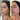 before and after biostimulator and full face   balance