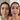 Before and after Biostimulator Radiesse and full face balance 
