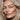 Close-up of a person who had non surgical face lift with hyaluronic acid filler 
