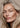 Close-up of a person who had non surgical face lift with hyaluronic acid filler 